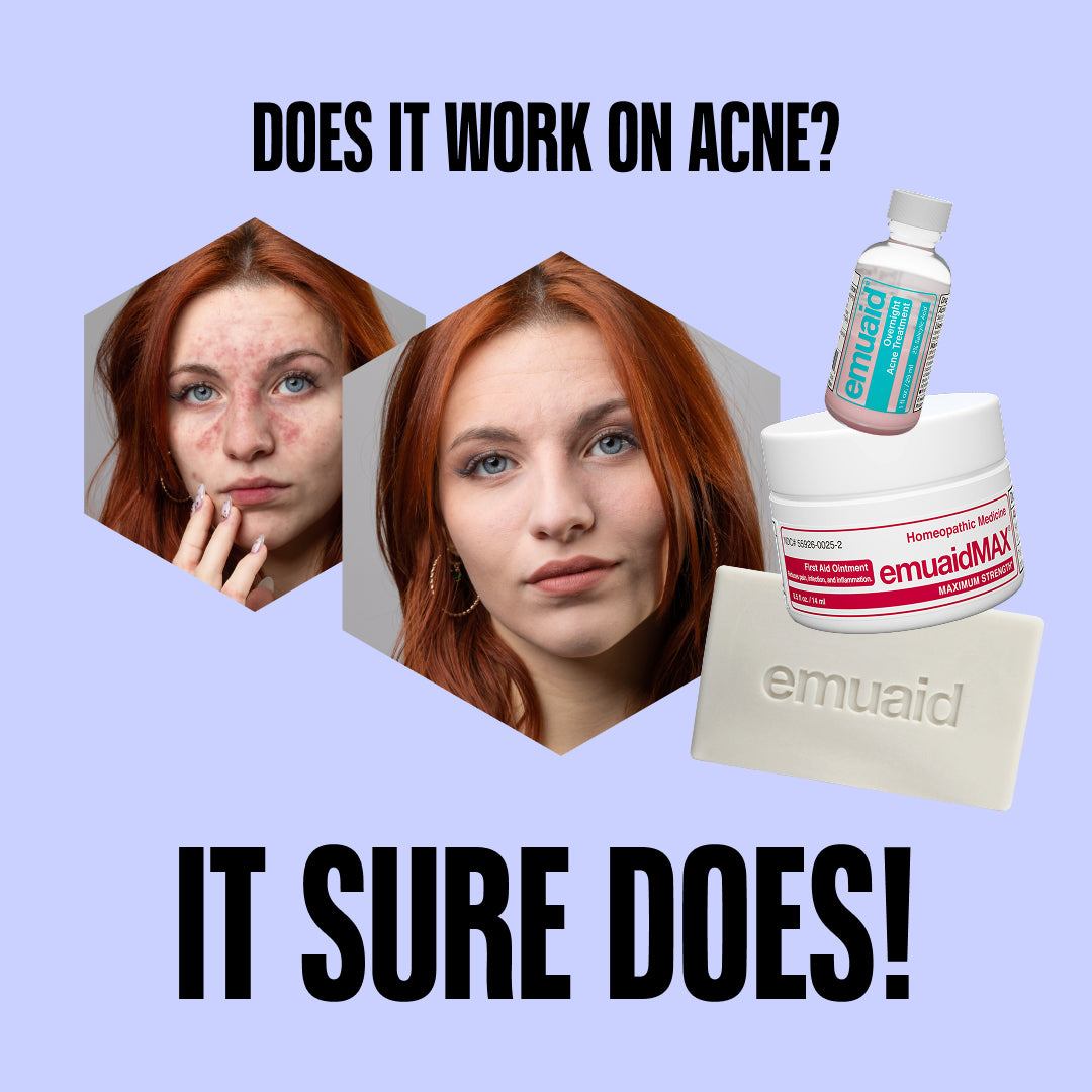 EMUAID Trio per la cancellazione dell'acne