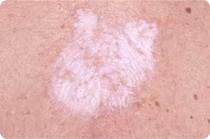 Soffri di Lichen Sclerosus?