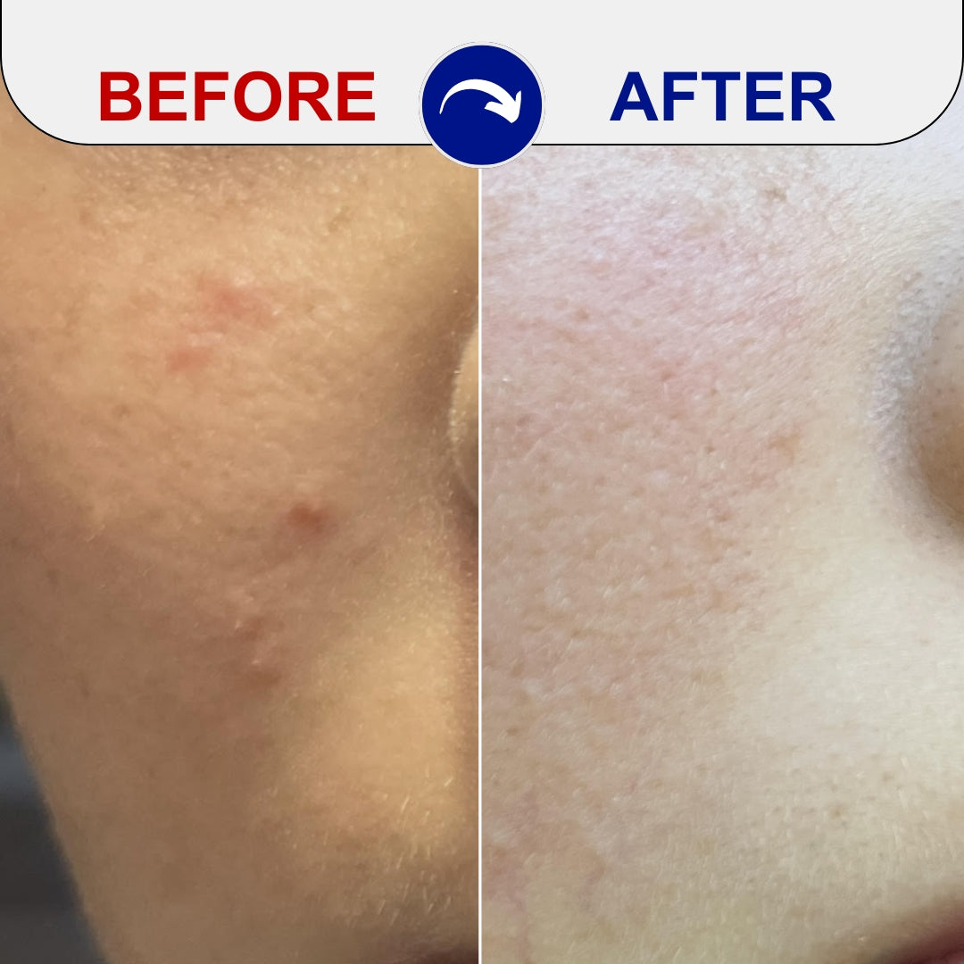 confronto tra il trattamento dell'acne prima e dopo