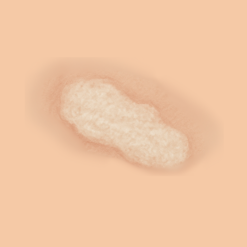 Immagine disegnata del lichen sclerosus
