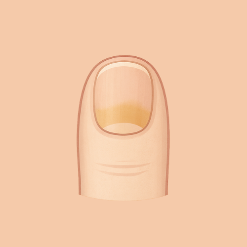 Immagine disegnata del fungo dell'unghia