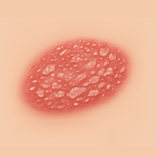 Immagine disegnata di una psoriasi