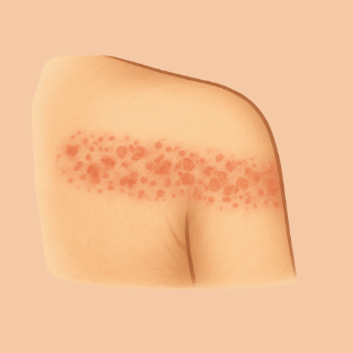 Immagine disegnata di un'eruzione cutanea sulla spalla