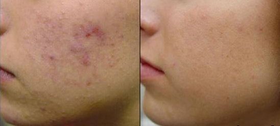 EMUAID Trattamento antiacne notturno 1 litro EMUAID Trattamento antiacne notturno 1 litro