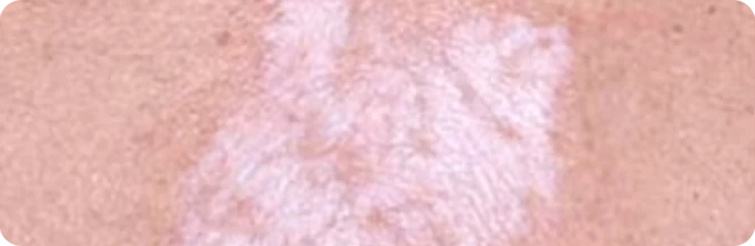 Soffri di Lichen Sclerosus?