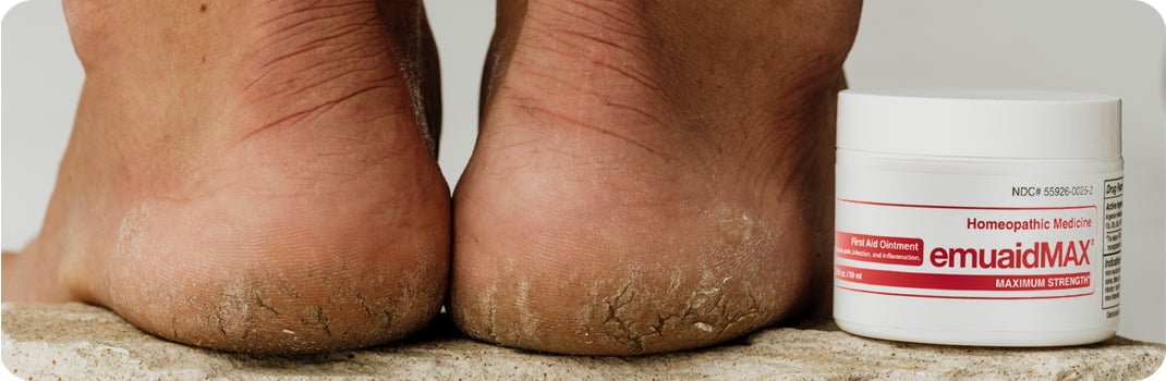 EMUAID gli agenti patogeni ed elimina le verruche plantari e palmarie senza congelamento o bruciatura*