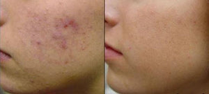 EMUAID Duo cancella acne