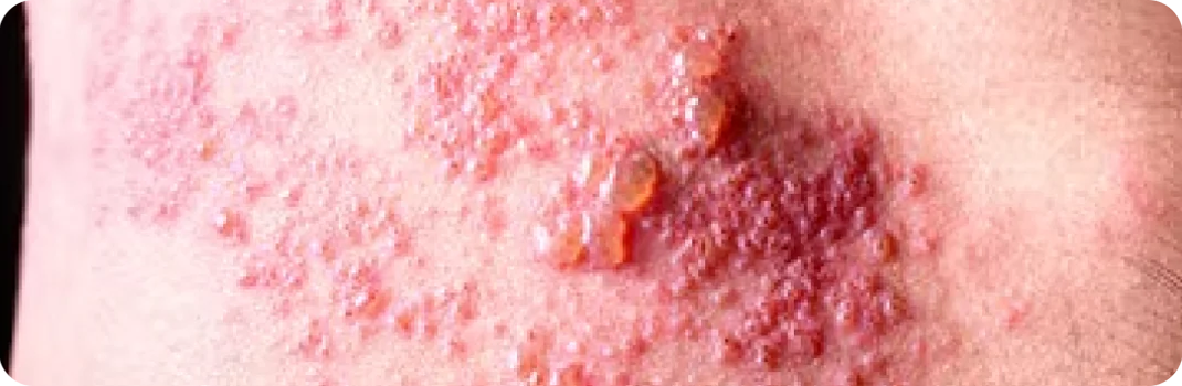 Soffri di herpes zoster?
